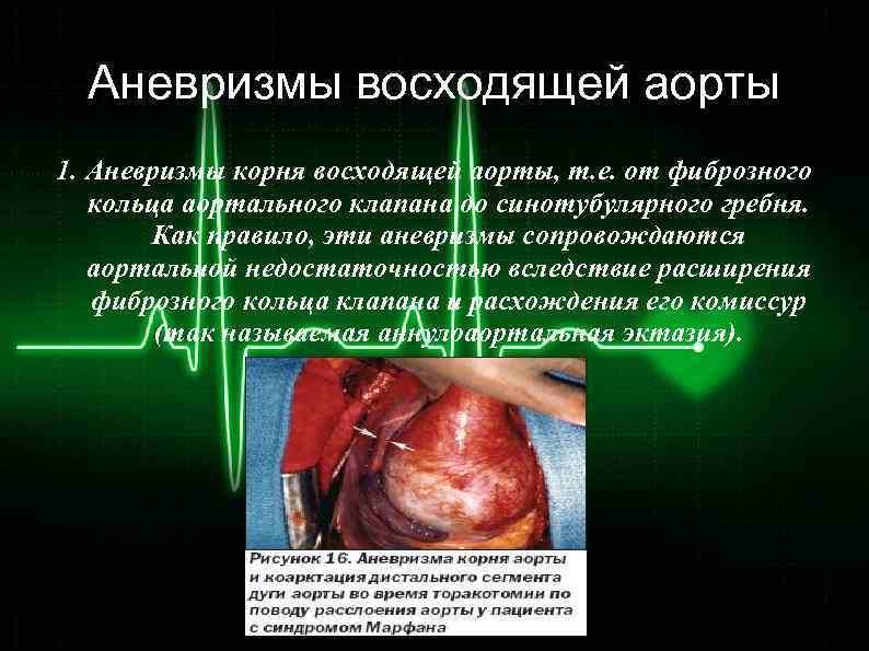 Аневризмы восходящей аорты 1. Аневризмы корня восходящей аорты, т. е. от фиброзного кольца аортального