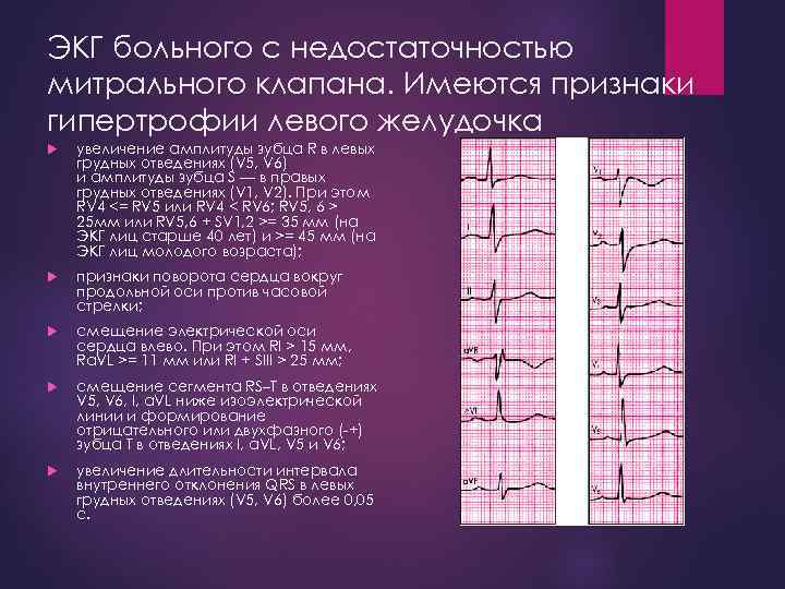 ЭКГ больного с недостаточностью митрального клапана. Имеются признаки гипертрофии левого желудочка увеличение амплитуды зубца