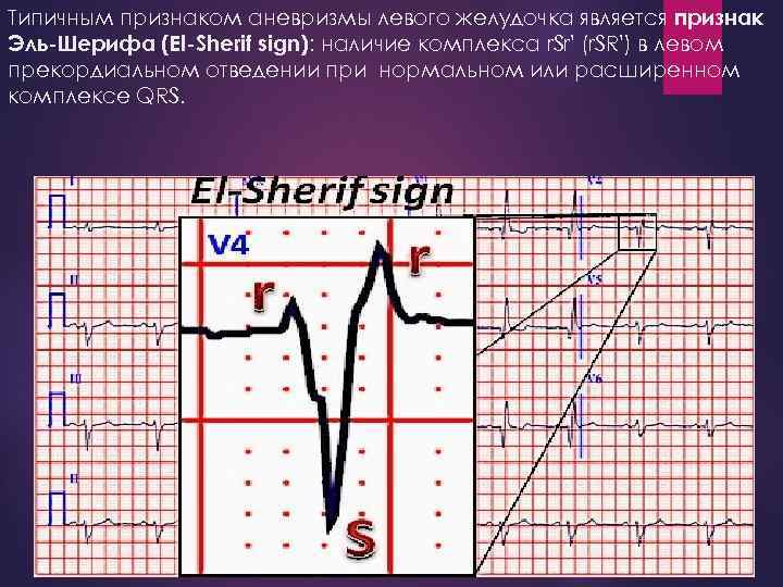 Типичным признаком аневризмы левого желудочка является признак Эль-Шерифа (El-Sherif sign): наличие комплекса r. Sr'