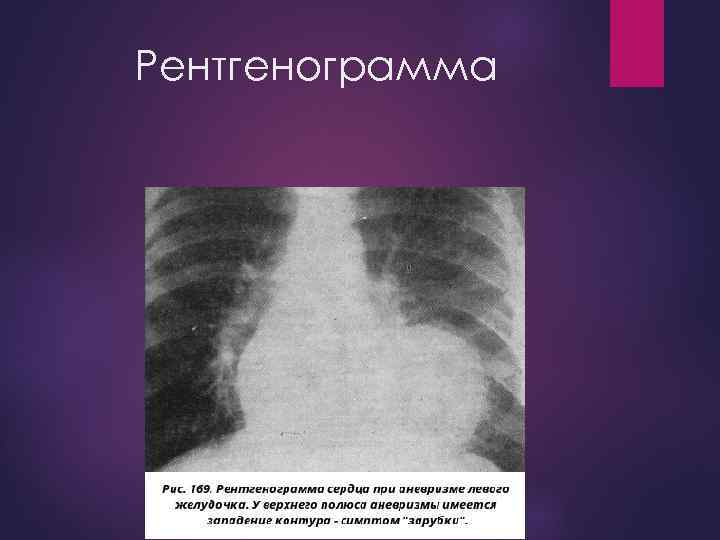 Рентгенограмма 