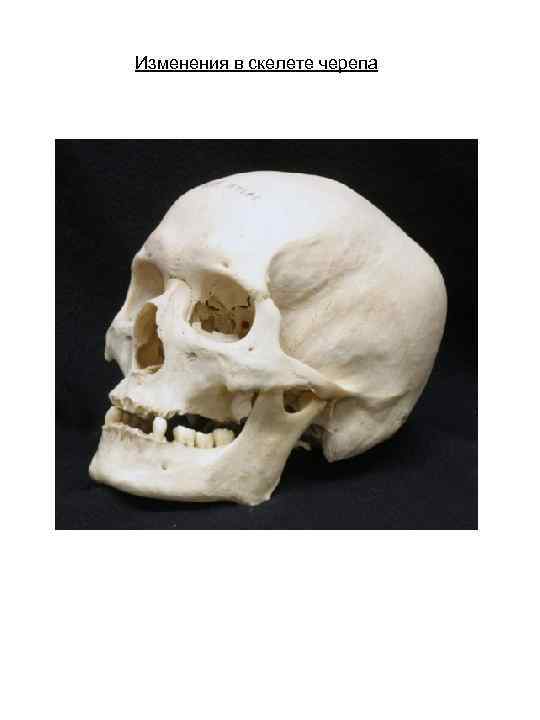 Изменения в скелете черепа 