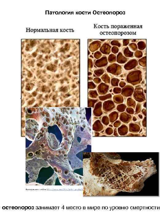 Патология кости Остеопороз остеопороз занимает 4 место в мире по уровню смертности 
