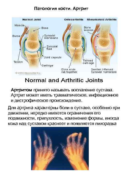 Патология кости. Артритом принято называть воспаление сустава. Артрит может иметь травматическое, инфекционное и дистрофическое