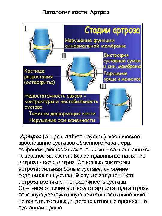 Патология кости. Артроз (от греч. arthron - сустав), хроническое заболевание суставов обменного характера, сопровождающееся