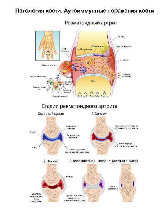 Патология кости. Аутоиммунные поражения кости 