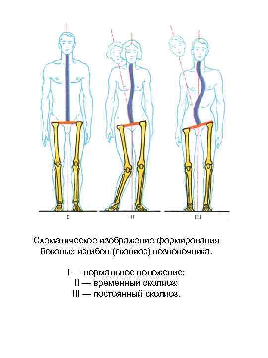 Схематическое изображение формирования боковых изгибов (сколиоз) позвоночника. I — нормальное положение; II — временный