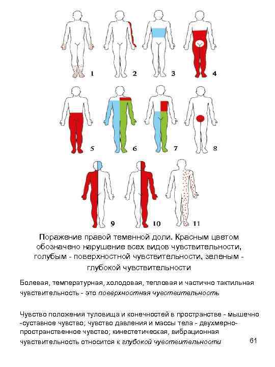 Поражение правой теменной доли. Красным цветом обозначено нарушение всех видов чувствительности, голубым - поверхностной