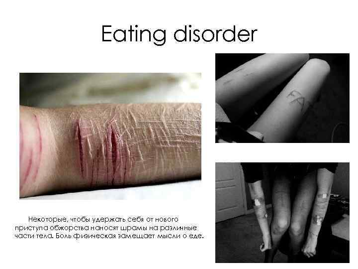 Eating disorder Некоторые, чтобы удержать себя от нового приступа обжорства наносят шрамы на различные