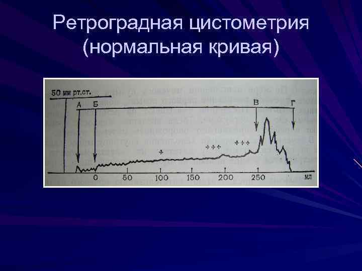 Ретроградная цистометрия (нормальная кривая) 