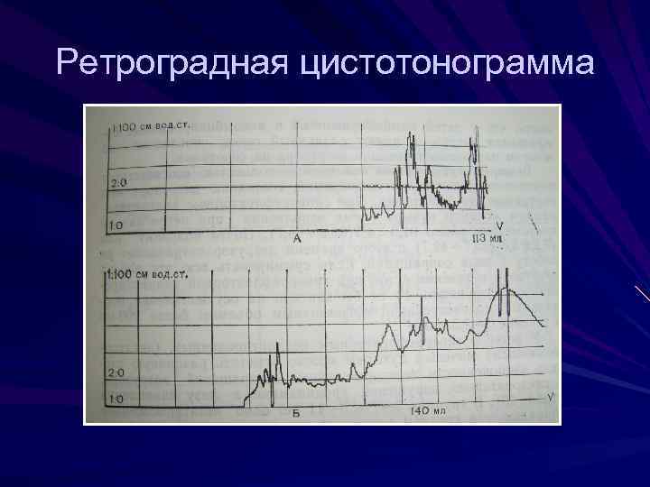 Нейрогенный мочевой пузырь мкб 10