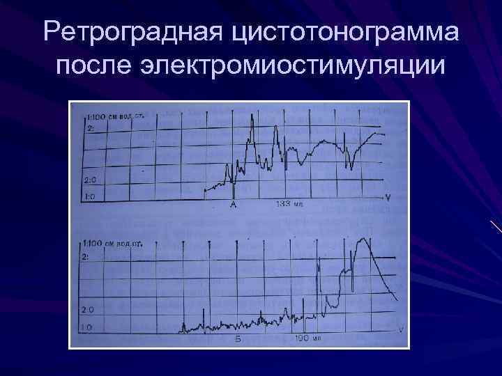 Ретроградная цистотонограмма после электромиостимуляции 