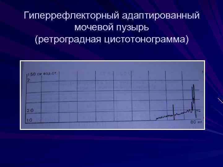 Нейрогенный мочевой пузырь мкб