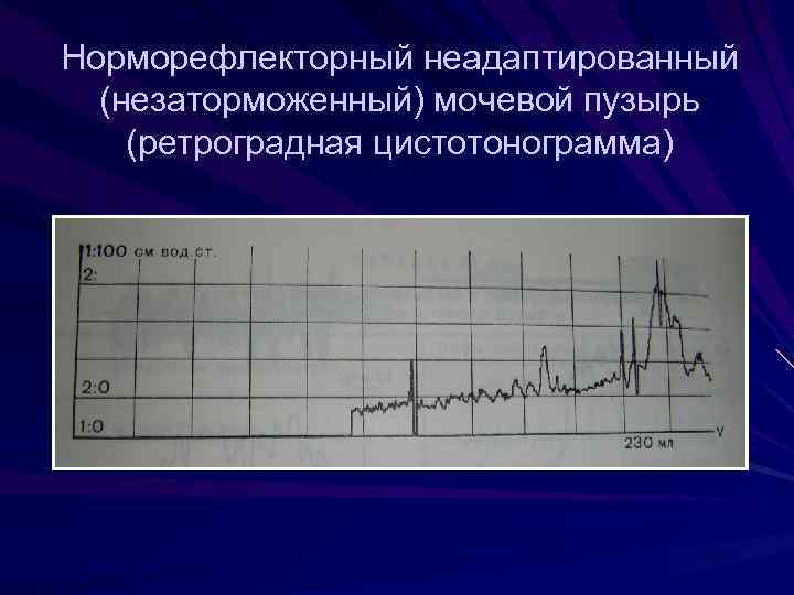 Нейрогенный мочевой пузырь мкб