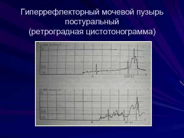 Нейрогенная дисфункция мочевого пузыря код мкб 10