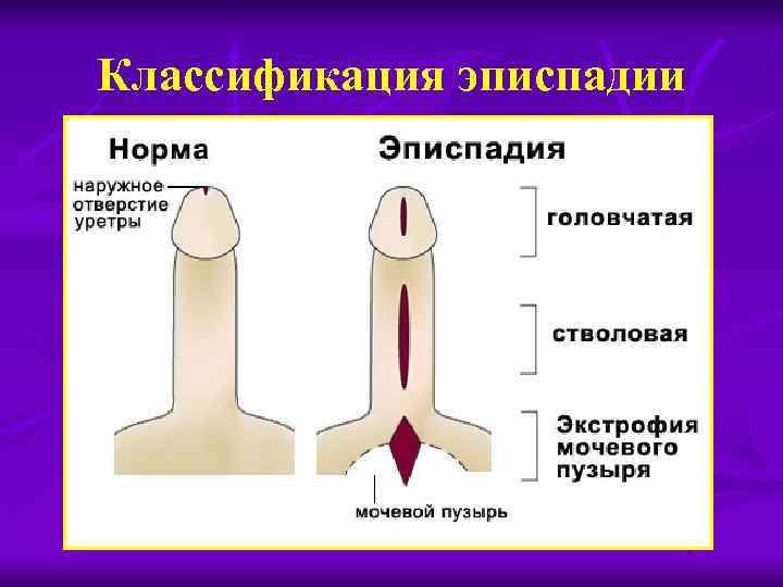 Классификация эписпадии 