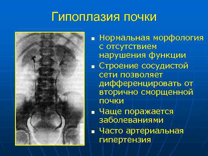 Нарушения развития почек. Гипоплазия почки рентген. Аномалии развития почек. Гипоплазия левой почки. Аномалии развития почек кт.