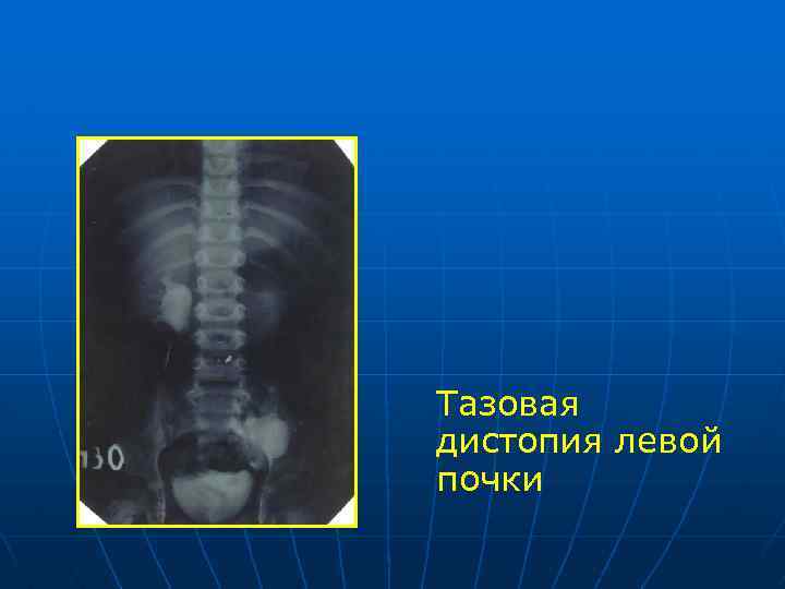 Нарушения развития почек. Торакальная дистопия почки на рентгене. Экскреторная урография дистопия. Гомолатеральная дистопия почки. Подвздошная дистопия почки рентген.