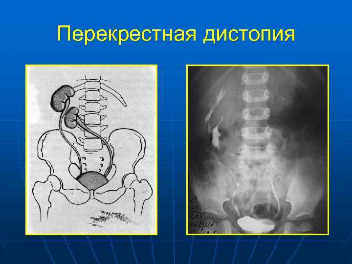 Дистопия левой почки