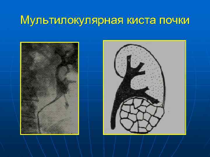 Кисты почек схема