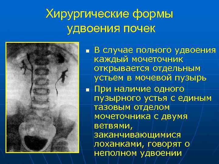 Аномалии мочеточников презентация