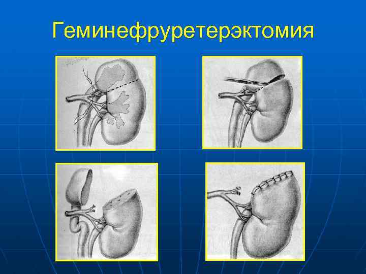 Аномалии развития почки картинки