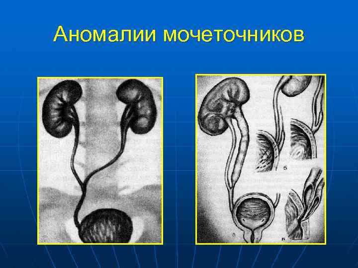 Нарушения развития почек. Аномалии формы мочеточников. Аномалии развития мочеточников. Пороки развития мочеточника. Врожденные аномалии почек.