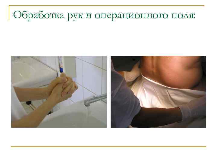Обработка рук и операционного поля: 