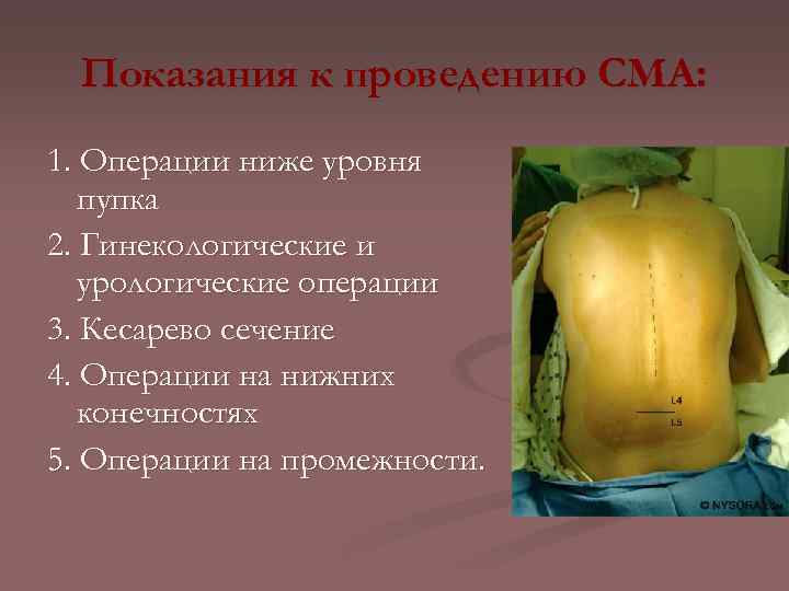 Показания к проведению СМА: 1. Операции ниже уровня пупка 2. Гинекологические и урологические операции