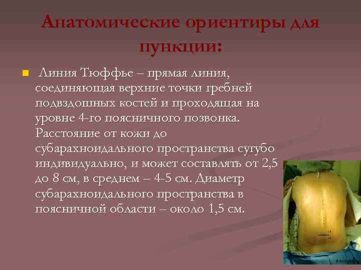 Анатомические ориентиры для пункции: n Линия Тюффье – прямая линия, соединяющая верхние точки гребней