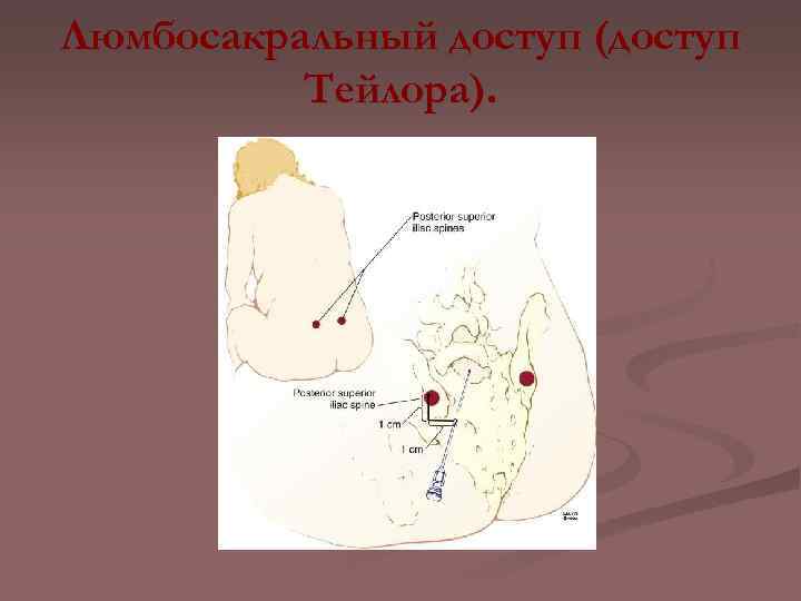 Люмбосакральный доступ (доступ Тейлора). 