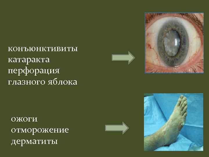 конъюнктивиты катаракта перфорация глазного яблока ожоги отморожение дерматиты 