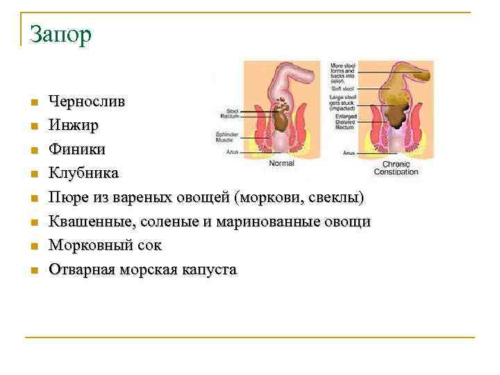 Запор n n n n Чернослив Инжир Финики Клубника Пюре из вареных овощей (моркови,
