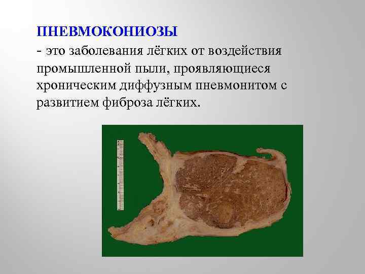 ПНЕВМОКОНИОЗЫ - это заболевания лёгких от воздействия промышленной пыли, проявляющиеся хроническим диффузным пневмонитом с