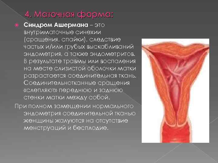 4. Маточная форма: Синдром Ашермана – это внутриматочные синехии (сращения, спайки), следствие частых и/или