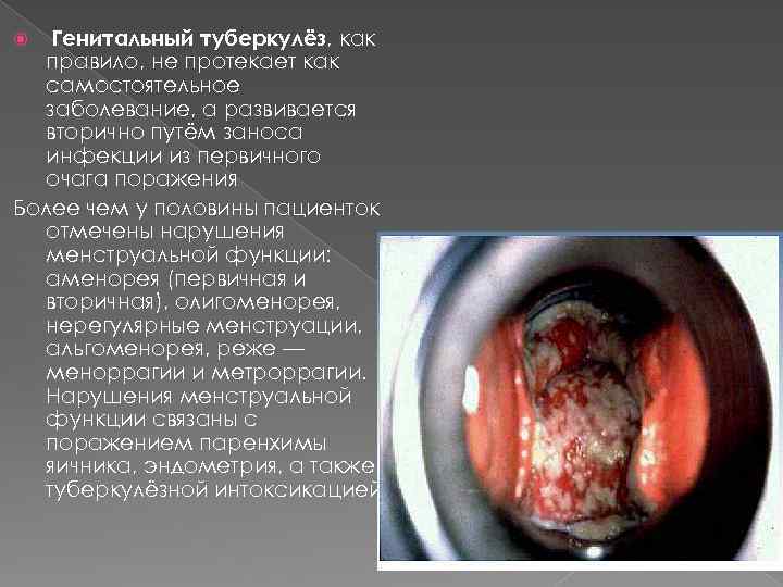  Генитальный туберкулёз, как правило, не протекает как самостоятельное заболевание, а развивается вторично путём