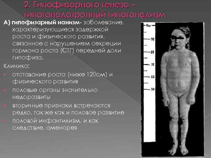 2. Гипофизарного генеза – гипогонадотропный гипогонадизм А) гипофизарный нанизм- заболевание, характеризующиеся задержкой роста и