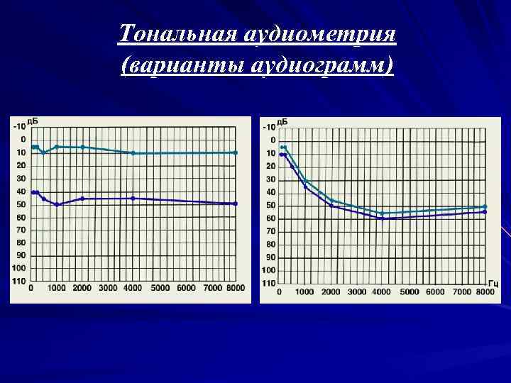 Тональная аудиометрия (варианты аудиограмм) 