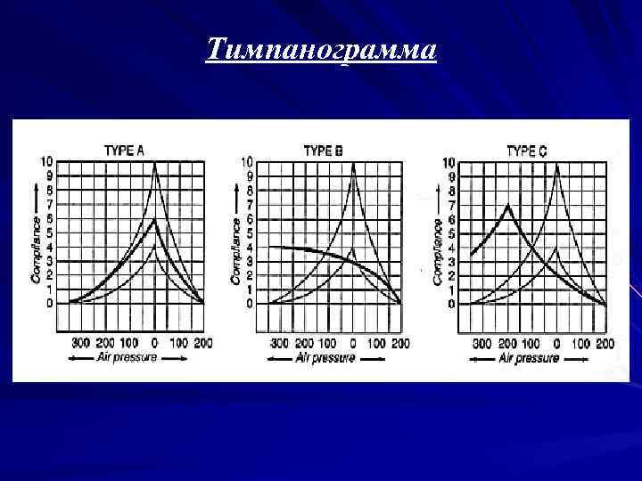 Тимпанограмма 
