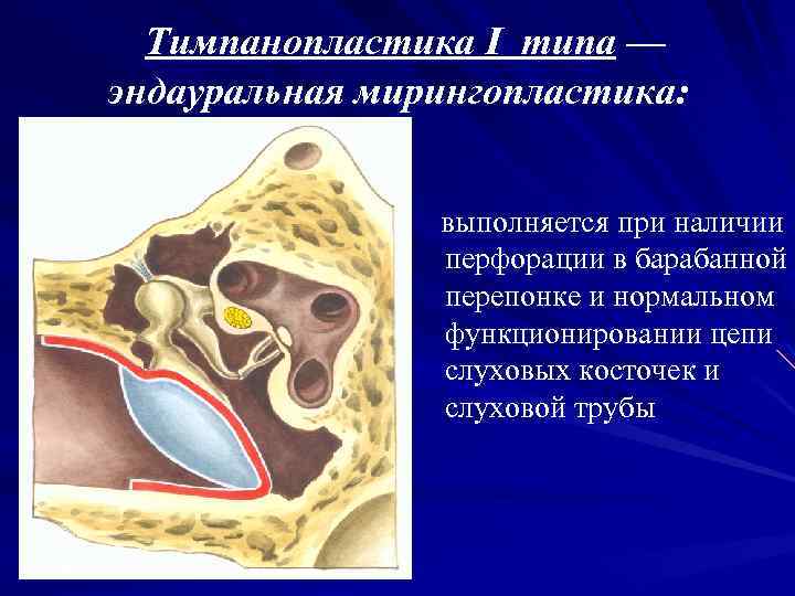 Тимпанопластика I типа — эндауральная мирингопластика: выполняется при наличии перфорации в барабанной перепонке и