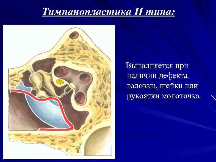 Тимпанопластика II типа: Выполняется при наличии дефекта головки, шейки или рукоятки молоточка 