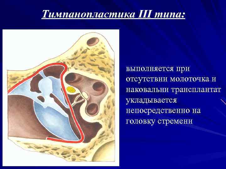 Тимпанопластика III типа: выполняется при отсутствии молоточка и наковальни трансплантат укладывается непосредственно на головку