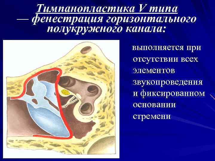 Тимпанопластика V типа — фенестрация горизонтального полукружного канала: выполняется при отсутствии всех элементов звукопроведения