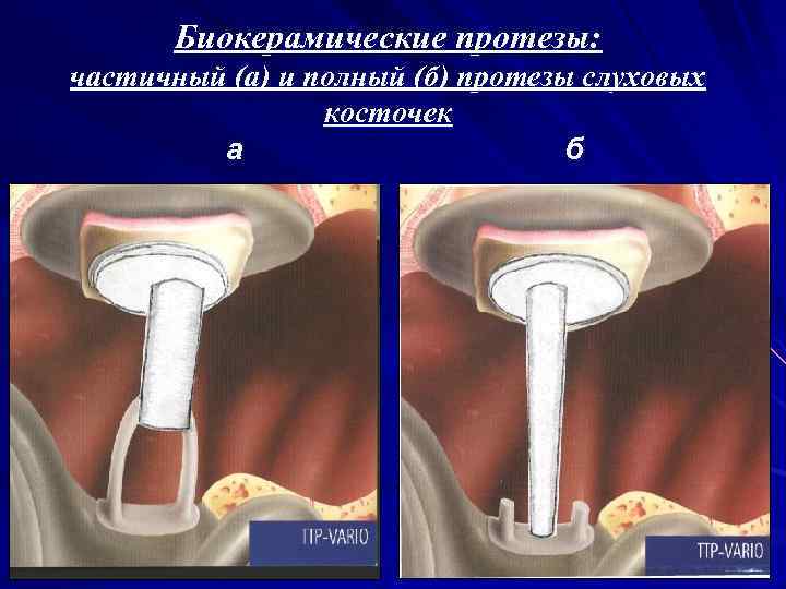 Биокерамические протезы: частичный (а) и полный (б) протезы слуховых косточек а б 