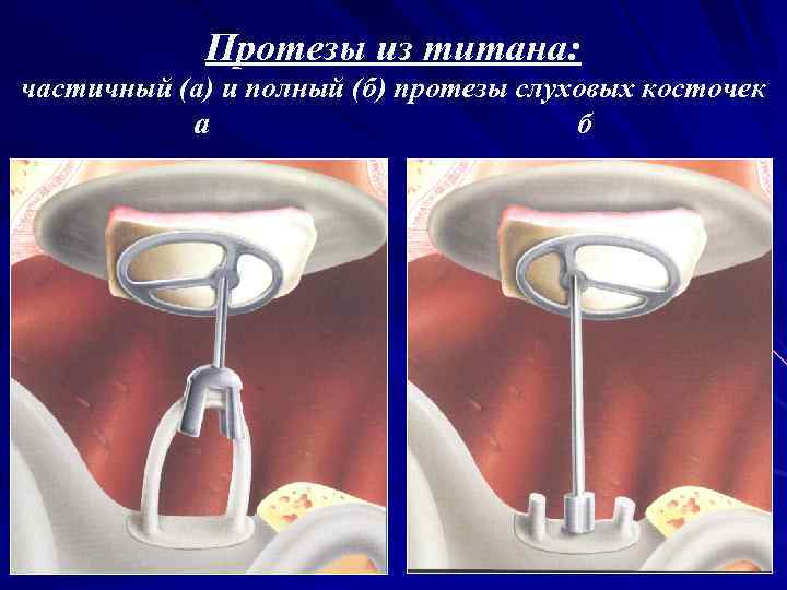 Протезы из титана: частичный (а) и полный (б) протезы слуховых косточек а б 