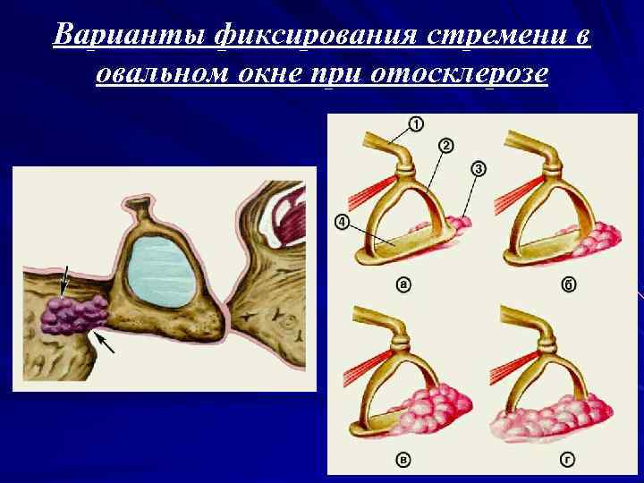 Варианты фиксирования стремени в овальном окне при отосклерозе 