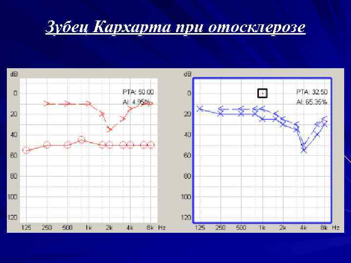 Зубец Кархарта при отосклерозе 
