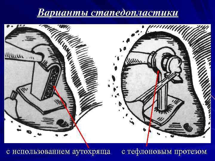 Варианты стапедопластики с использованием аутохряща с тефлоновым протезом 