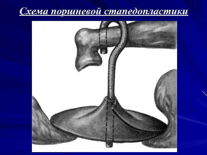 Схема поршневой стапедопластики 
