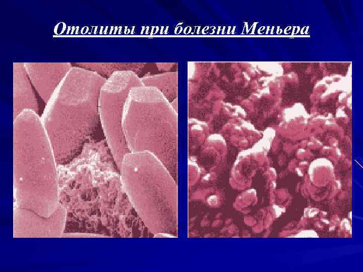 Отолиты при болезни Меньера 