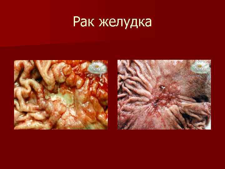 Рак желудка 